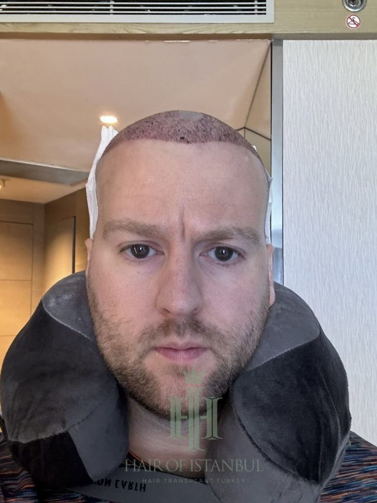 Hair transplant result, 2,700 grafts, Day 1 — Hair of Istanbul