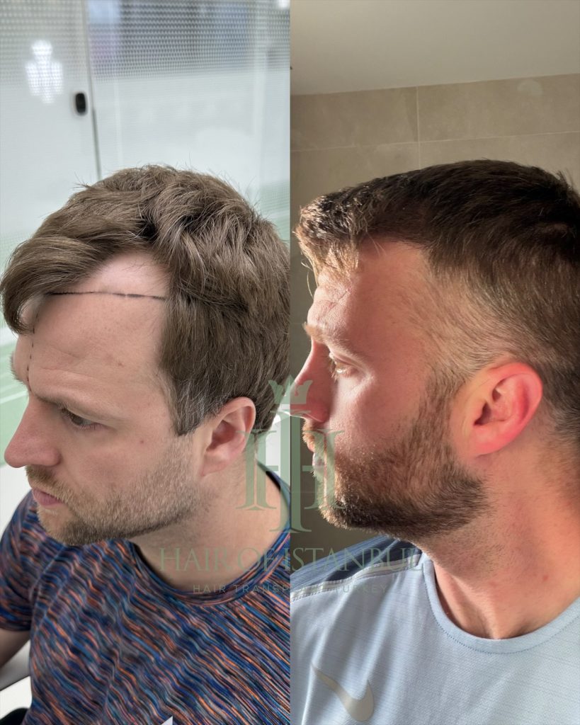 Hair transplant result, 2,700 grafts, Before & After (4) — Hair of Istanbul