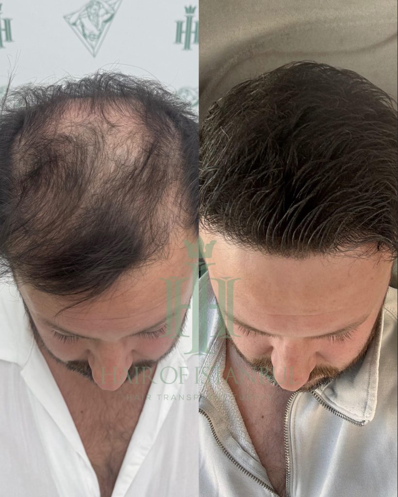 Hair transplant result, 4,300 grafts, Month 11 (5) — Hair of Istanbul