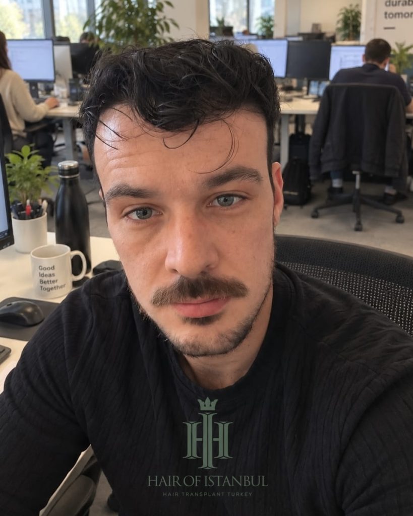 Before & After 15 Hair transplant result, 4,550 grafts, Month 12 (2) — Hair of Istanbul