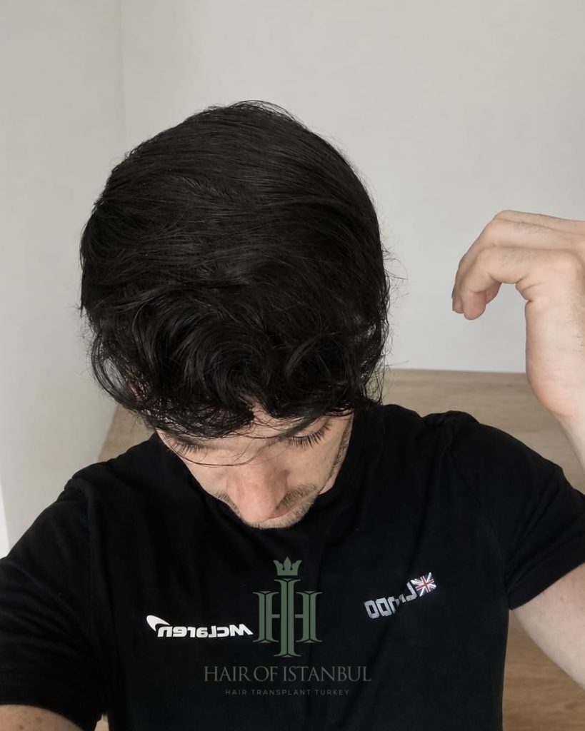 Before & After 14 Hair transplant result, 4,550 grafts, Month 12 — Hair of Istanbul