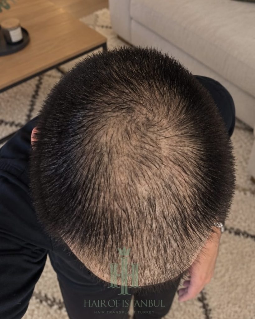 Before & After 12 Hair transplant result, 4,550 grafts, Month 3 — Hair of Istanbul
