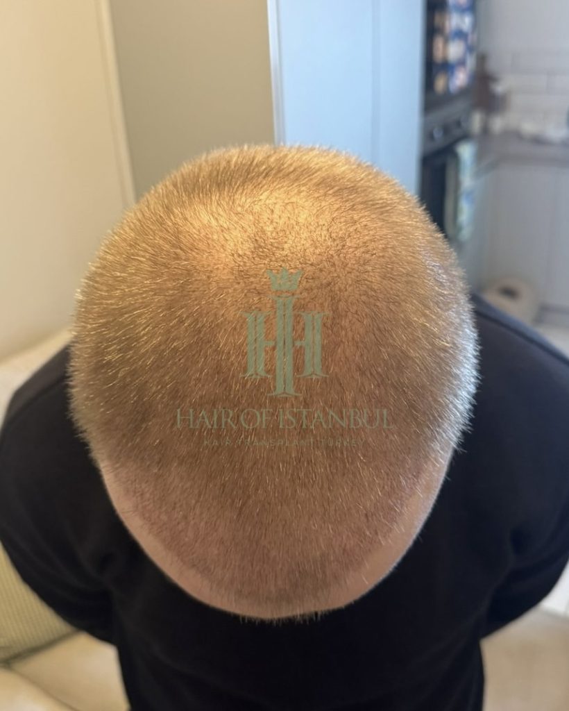 Before & After 27 Hair transplant result, 4,150 grafts, Month 3 — Hair of Istanbul