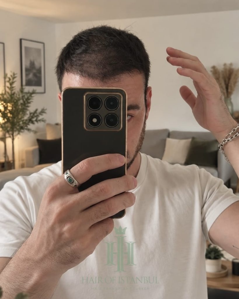 Before & After 13 Hair transplant result, 4,550 grafts, Month 4 — Hair of Istanbul