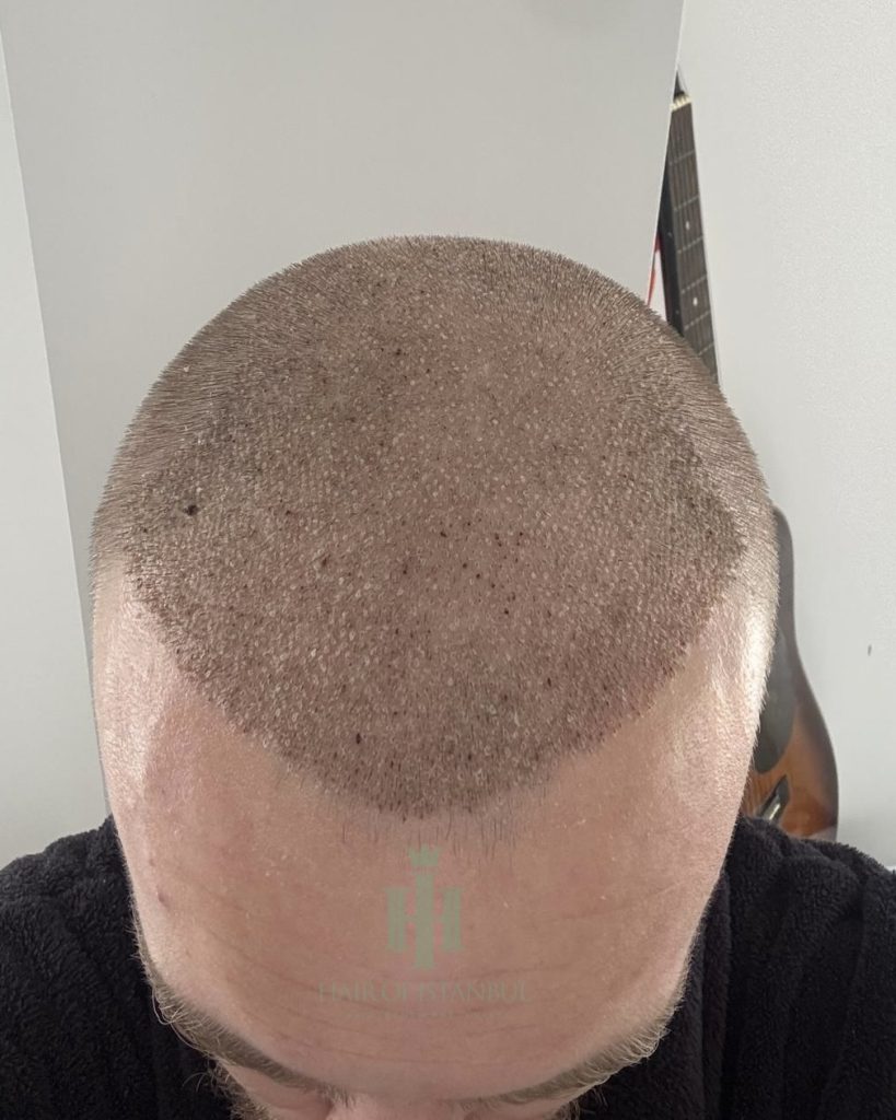 Before & After 26 Hair transplant result, 4,150 grafts, Day 10 — Hair of Istanbul