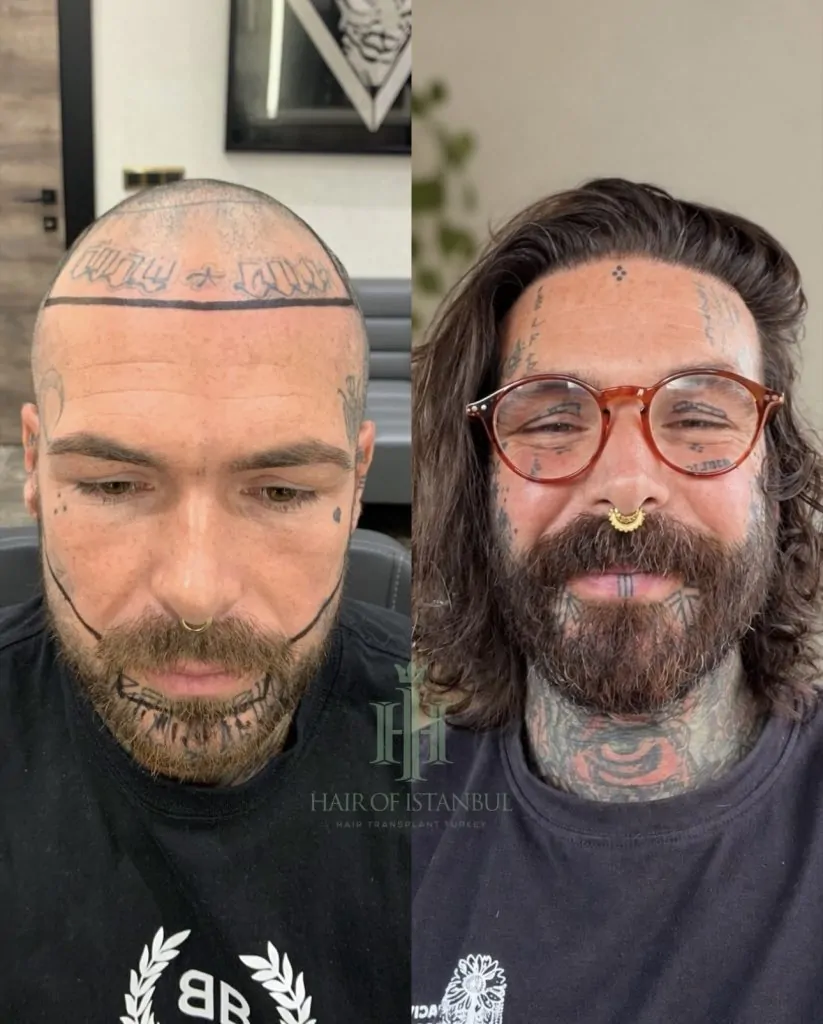 Before & After 33 Hair transplant result, 4,900 grafts, Before & After — Hair of Istanbul