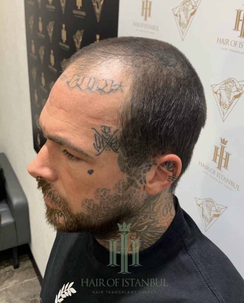 Before & After 35 Hair transplant result, 4,900 grafts, Before (2) — Hair of Istanbul