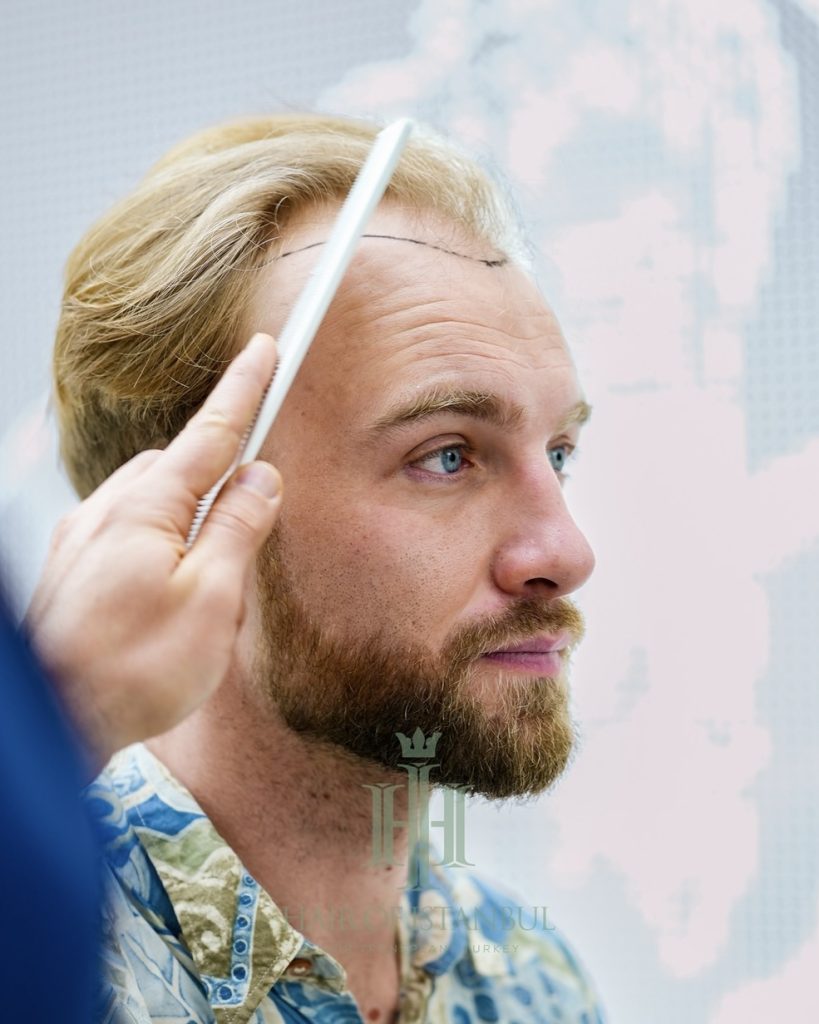 Before & After 23 Hair transplant result, 4,150 grafts, Before (4) — Hair of Istanbul