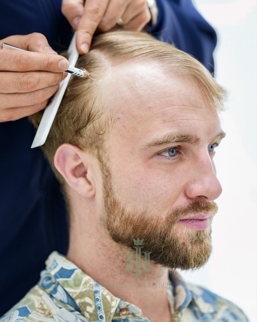Before & After 22 Hair transplant result, 4,150 grafts, Before (3) — Hair of Istanbul