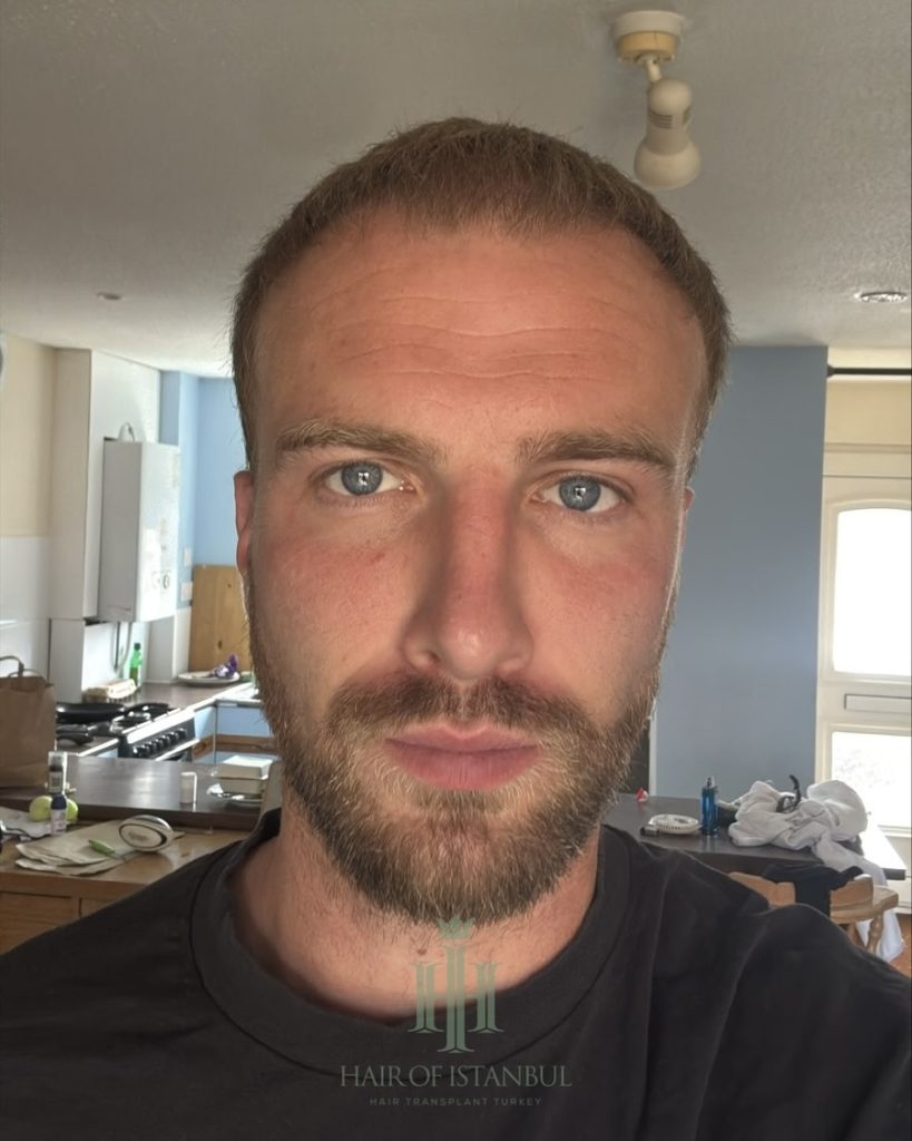 Before & After 28 Hair transplant result, 4,150 grafts, Month 4 — Hair of Istanbul