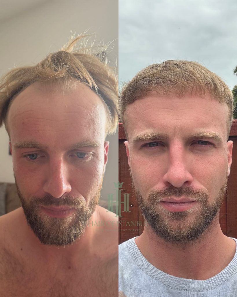 Before & After 19 Hair transplant result, 4,150 grafts, Before & After — Hair of Istanbul
