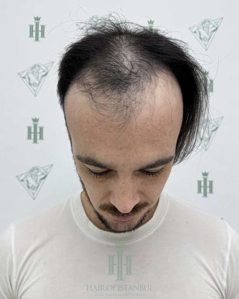 Before & After 2 Hair transplant result, 4,550 grafts, Before — Hair of Istanbul