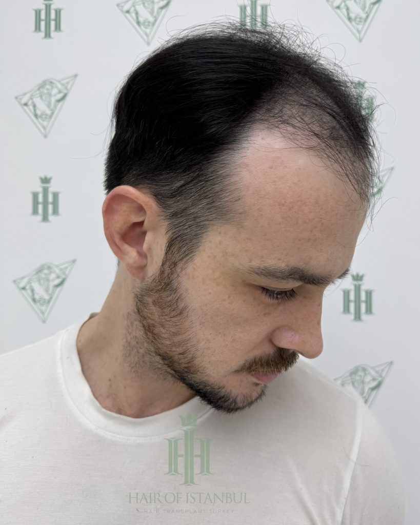 Before & After 4 Hair transplant result, 4,550 grafts, Before (3) — Hair of Istanbul