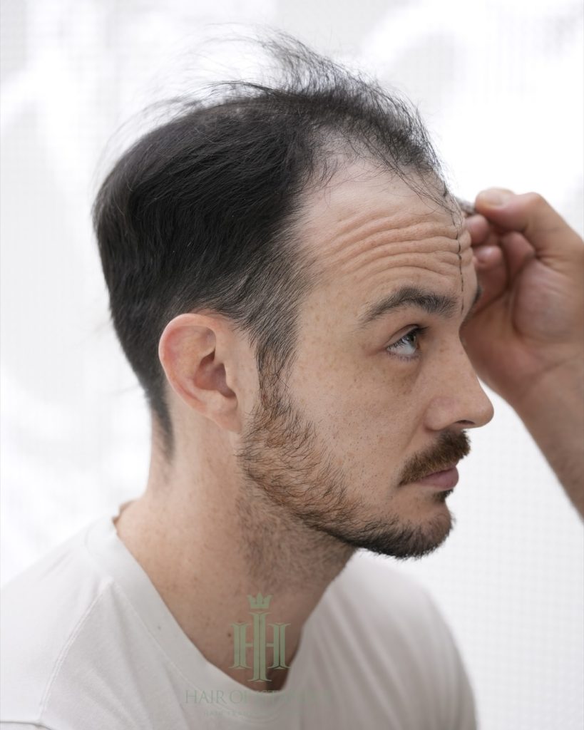 Before & After 5 Hair transplant result, 4,550 grafts, Before (4) — Hair of Istanbul