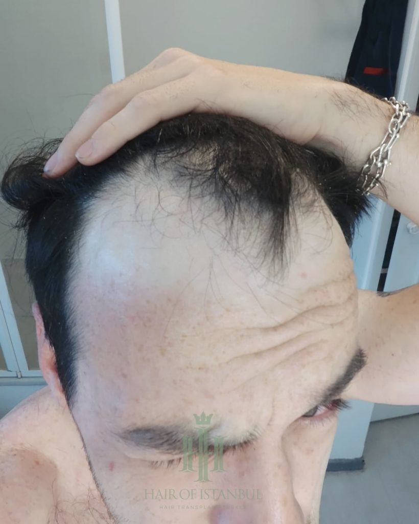 Before & After 6 Hair transplant result, 4,550 grafts, Before (5) — Hair of Istanbul