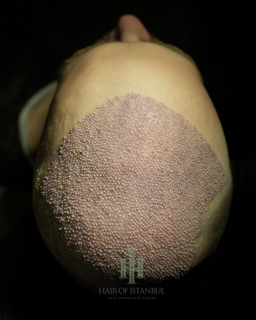 Before & After 25 Hair transplant result, 4,150 grafts, Before & After (2) — Hair of Istanbul