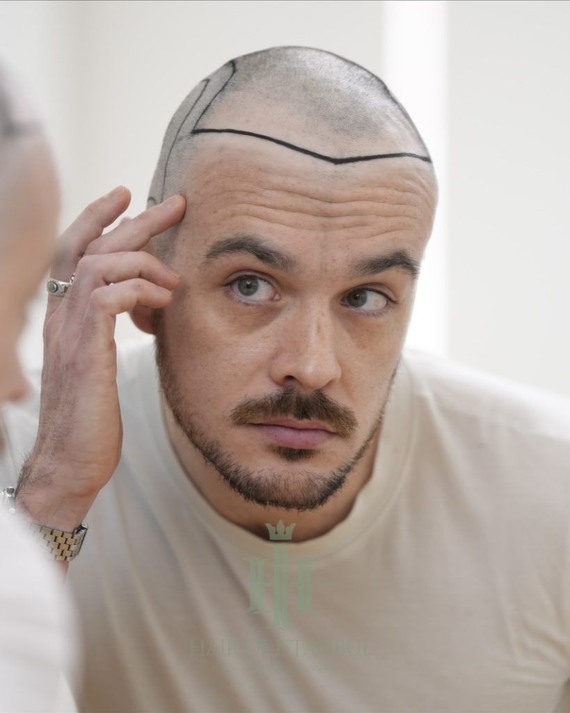 Before & After 9 Hair transplant result, 4,550 grafts, Hairline design (2) — Hair of Istanbul