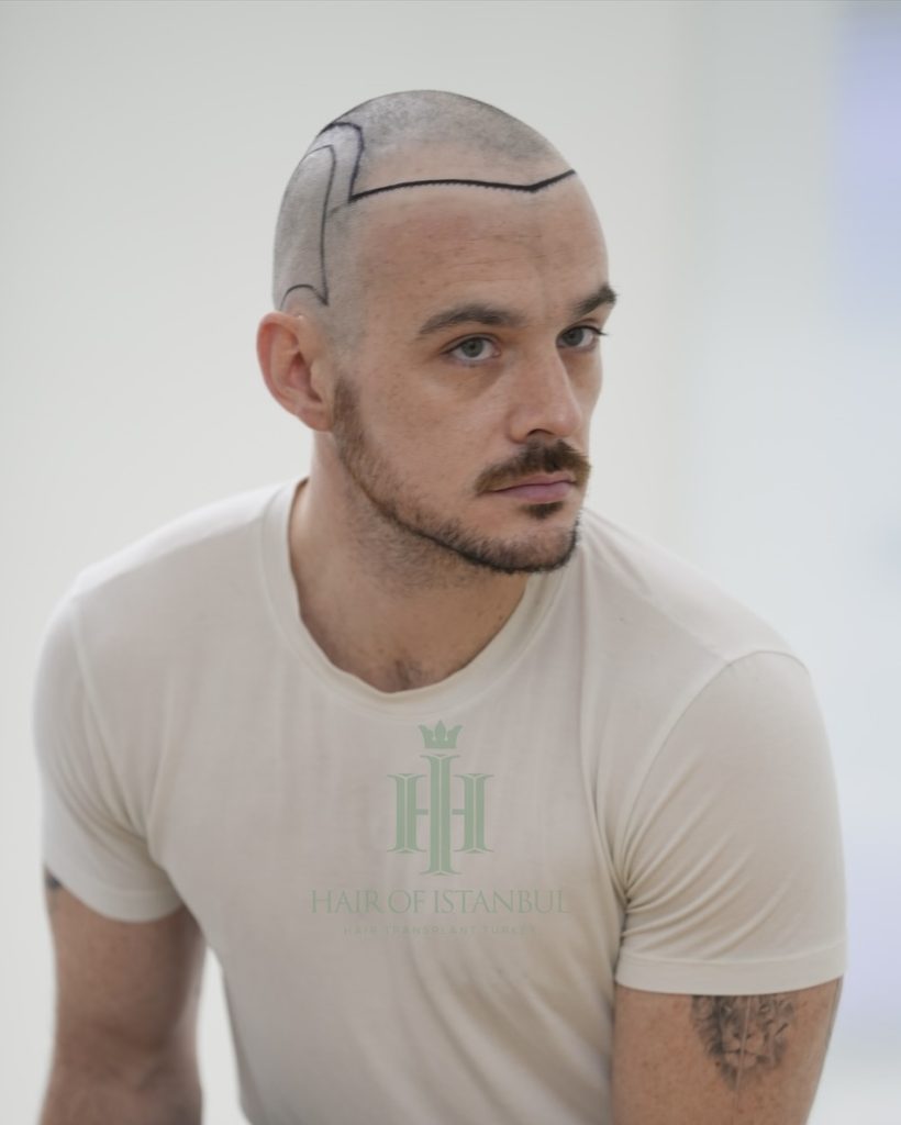 Before & After 10 Hair transplant result, 4,550 grafts, Hairline design (3) — Hair of Istanbul