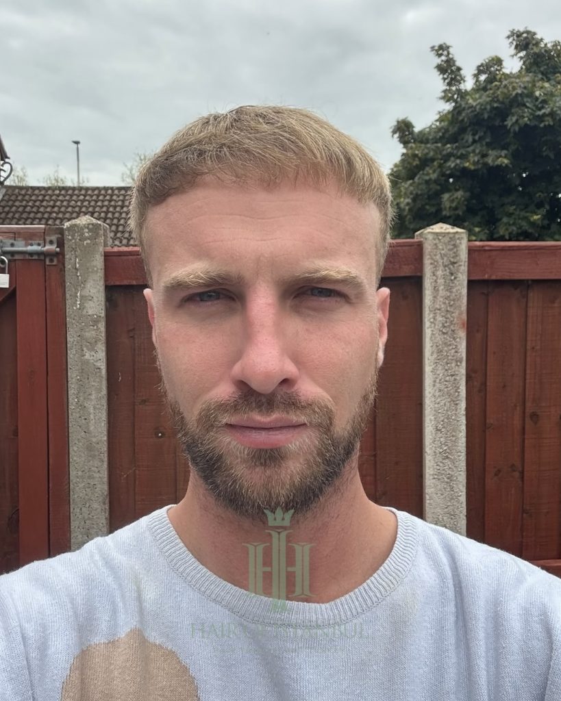 Before & After 29 Hair transplant result, 4,150 grafts, Month 7 — Hair of Istanbul