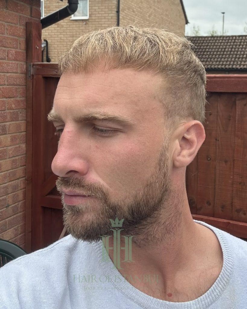 Before & After 30 Hair transplant result, 4,150 grafts, Month 7 (2) — Hair of Istanbul