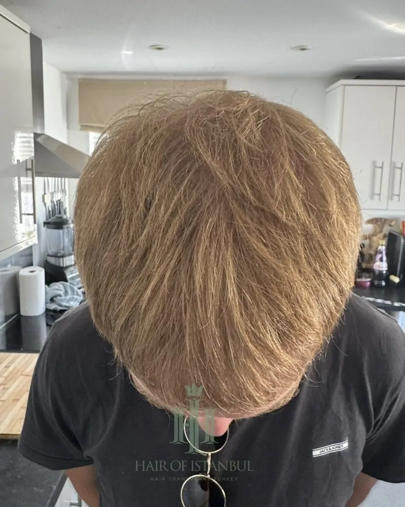Before & After 31 Hair transplant result, 4,150 grafts, Month 7 (3) — Hair of Istanbul