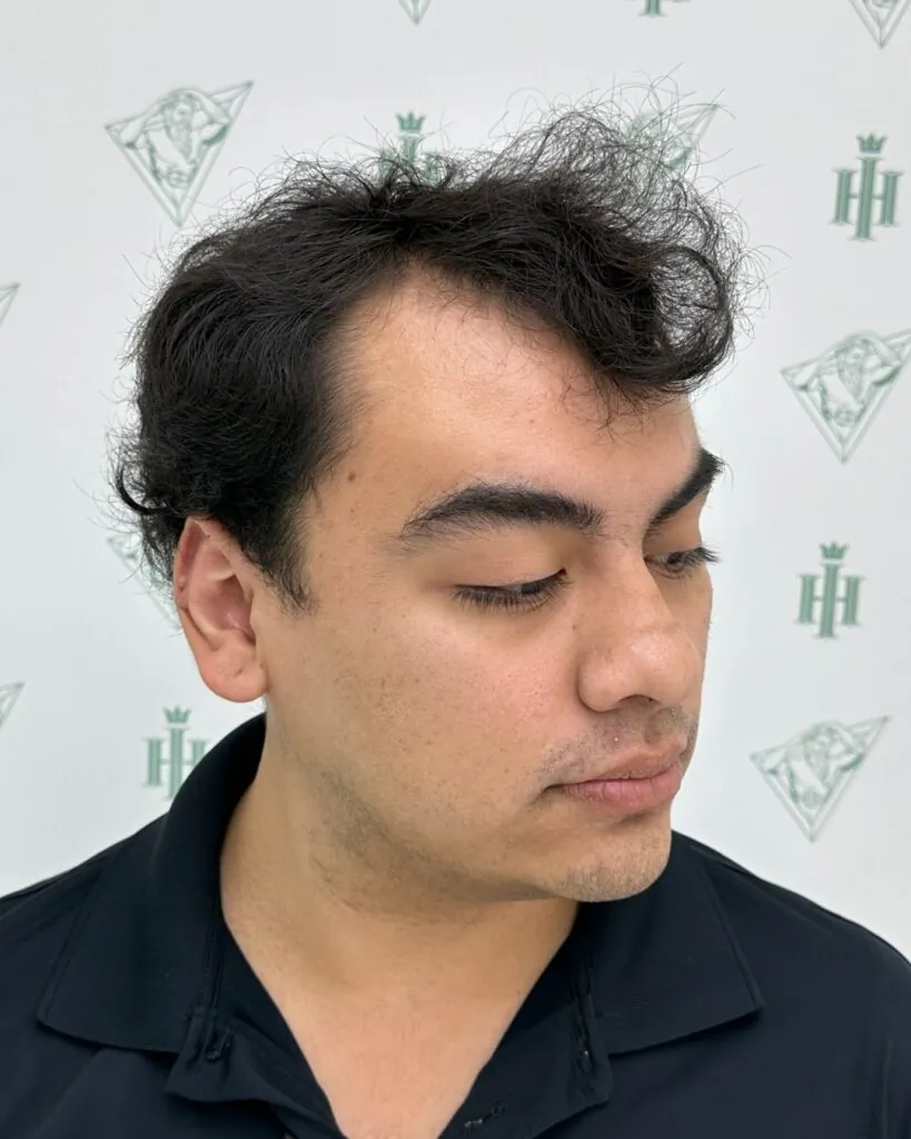 Saç ekimi sonucu, 5.800 greft, Öncesi (3) — Hair of Istanbul