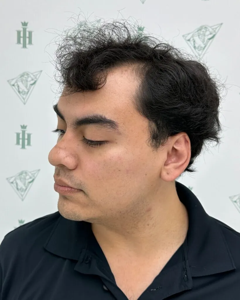 Saç ekimi sonucu, 5.800 greft, Öncesi (4) — Hair of Istanbul