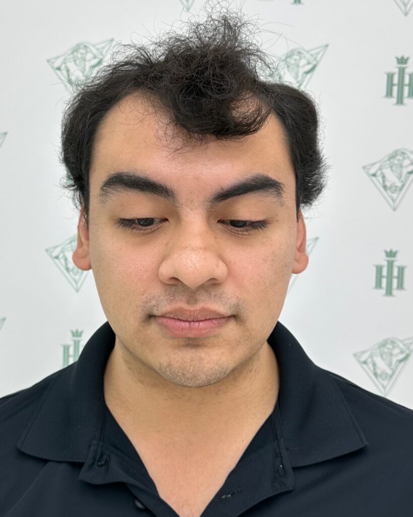 Saç ekimi sonucu, 5.800 greft, Öncesi — Hair of Istanbul