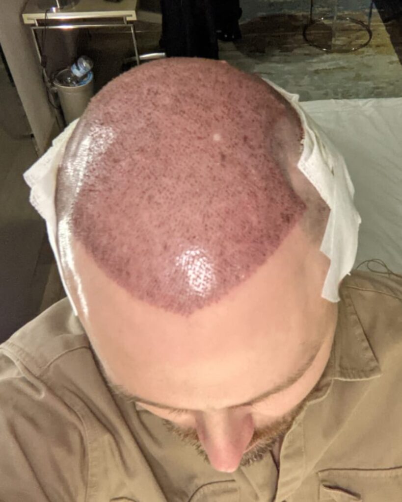Saç ekimi sonucu, 4.500 greft, 1. gün — Hair of Istanbul