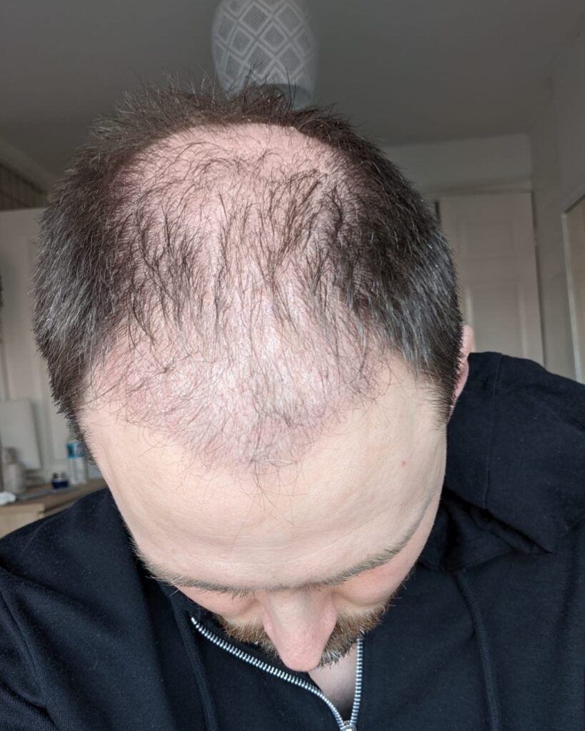 Saç ekimi sonucu, 4.500 greft, 1. ay (3) — Hair of Istanbul