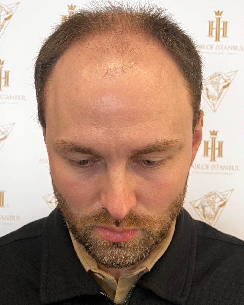 Saç ekimi sonucu, 4.500 greft, Öncesi — Hair of Istanbul