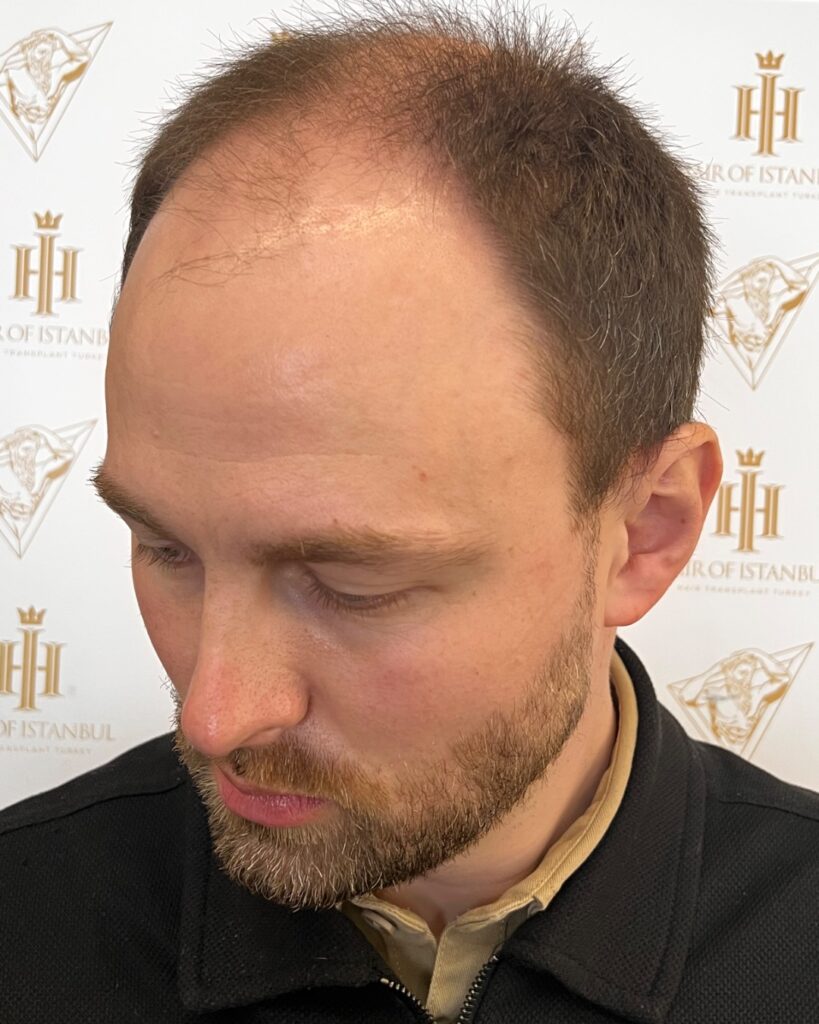 Saç ekimi sonucu, 4.500 greft, Öncesi (2) — Hair of Istanbul
