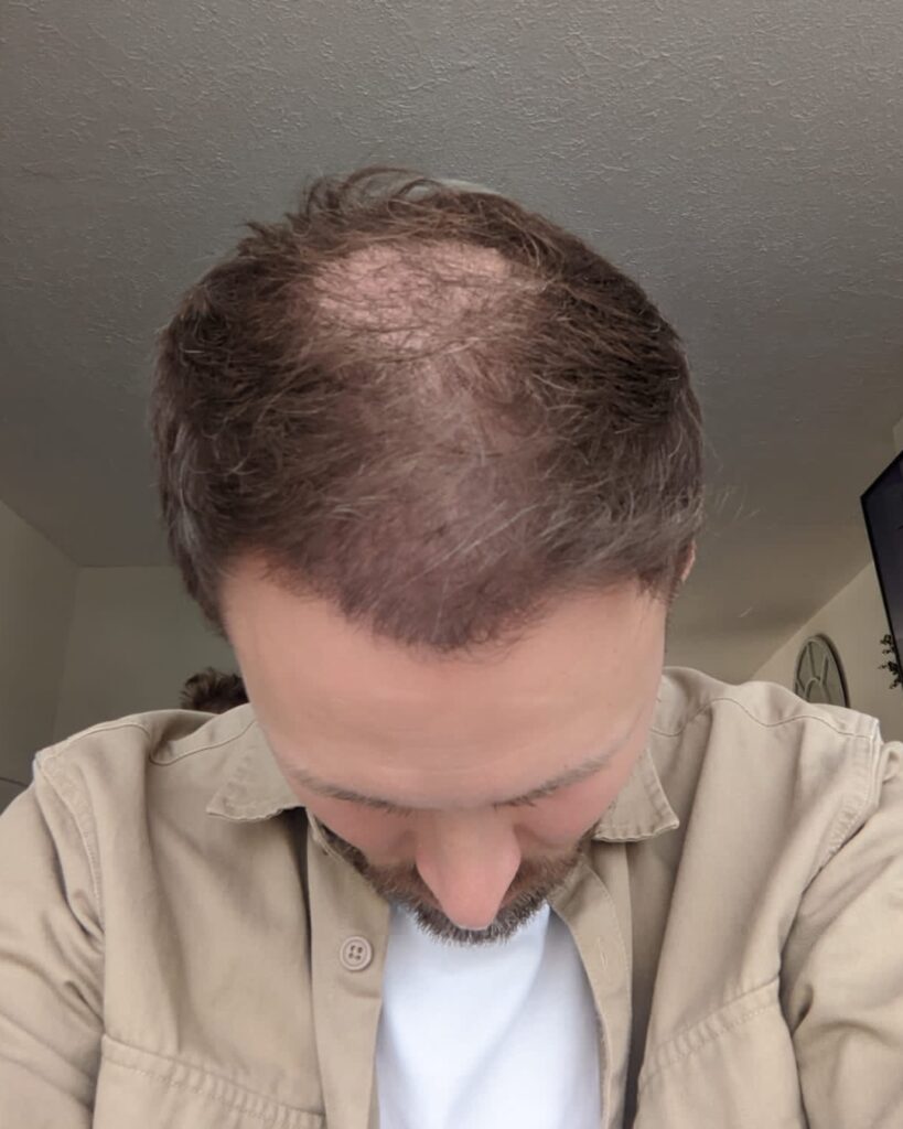 Saç ekimi sonucu, 4.500 greft, 5. ay (4) — Hair of Istanbul