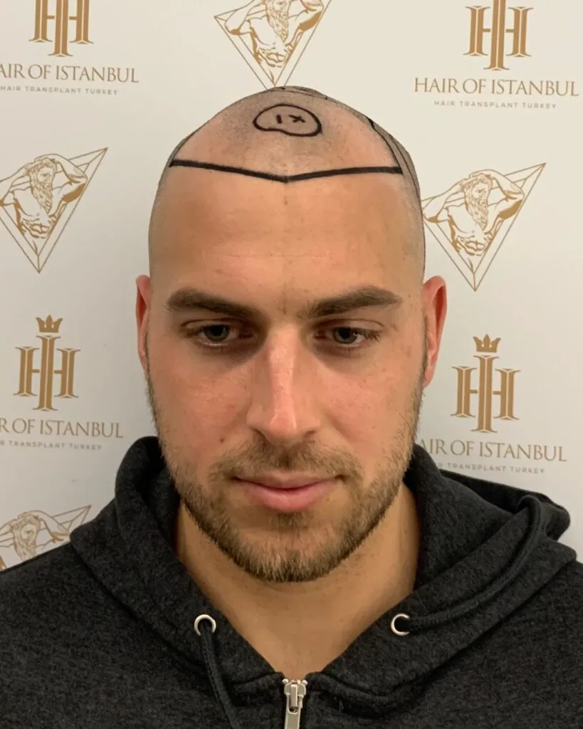 Saç ekimi sonucu, 4.200 greft, Saç çizgisi tasarımı — Hair of Istanbul
