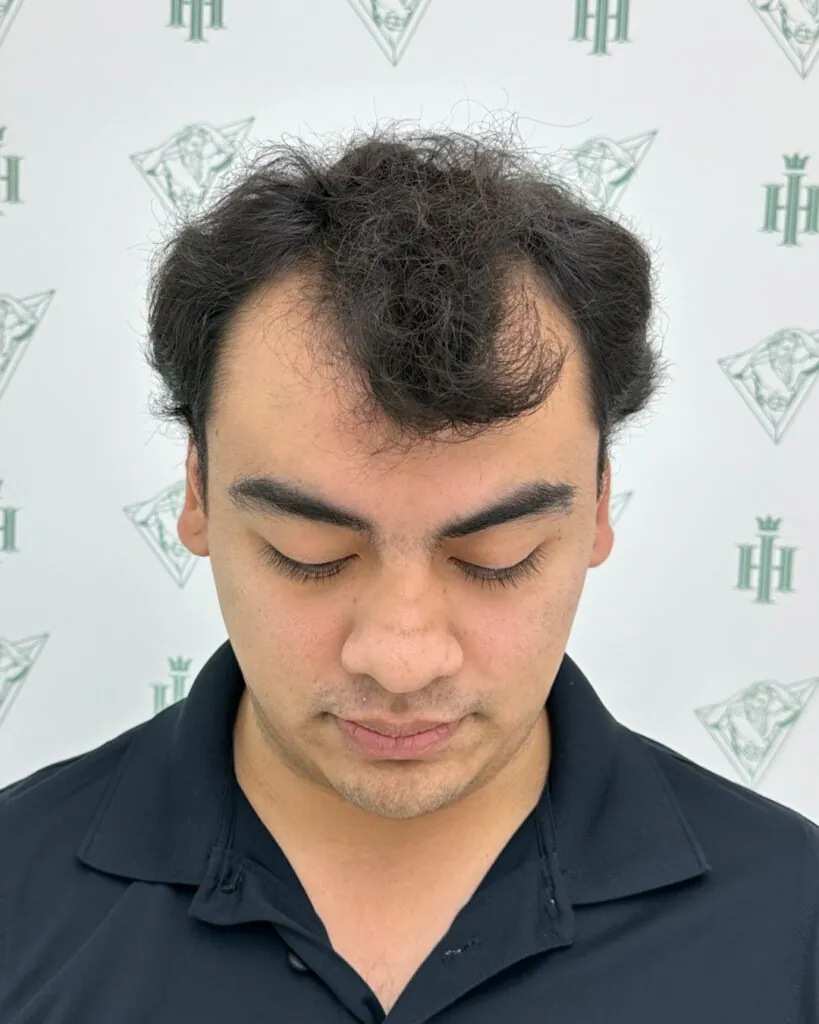 Saç ekimi sonucu, 5.800 greft, Öncesi (2) — Hair of Istanbul