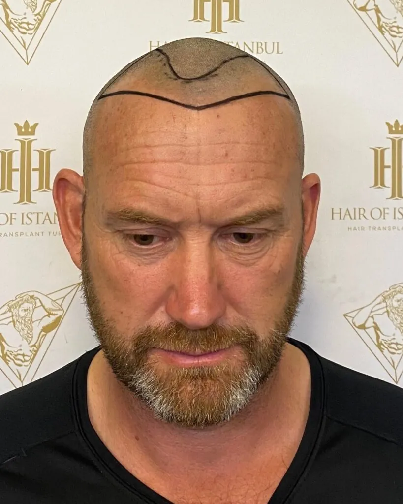 Saç ekimi sonucu, 3.000 greft, Saç çizgisi tasarımı — Hair of Istanbul