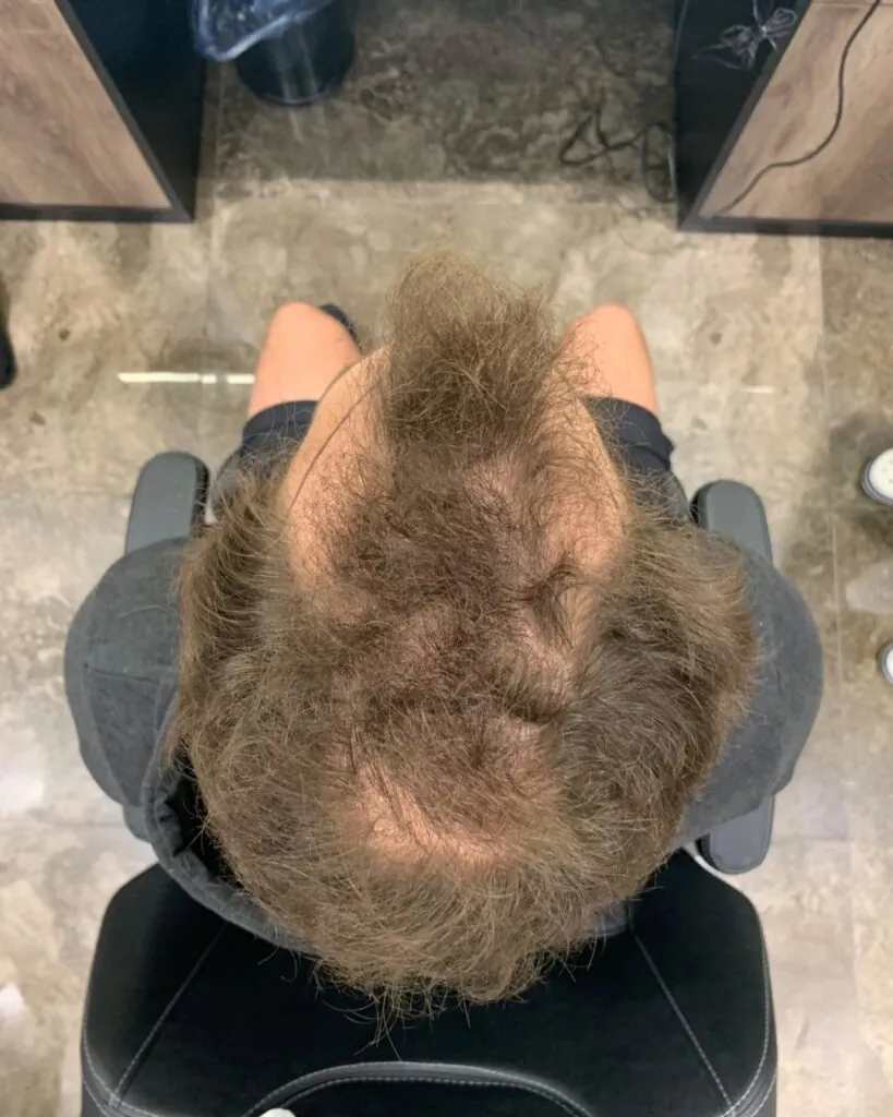 Saç ekimi sonucu, 4.200 greft, Öncesi (4) — Hair of Istanbul