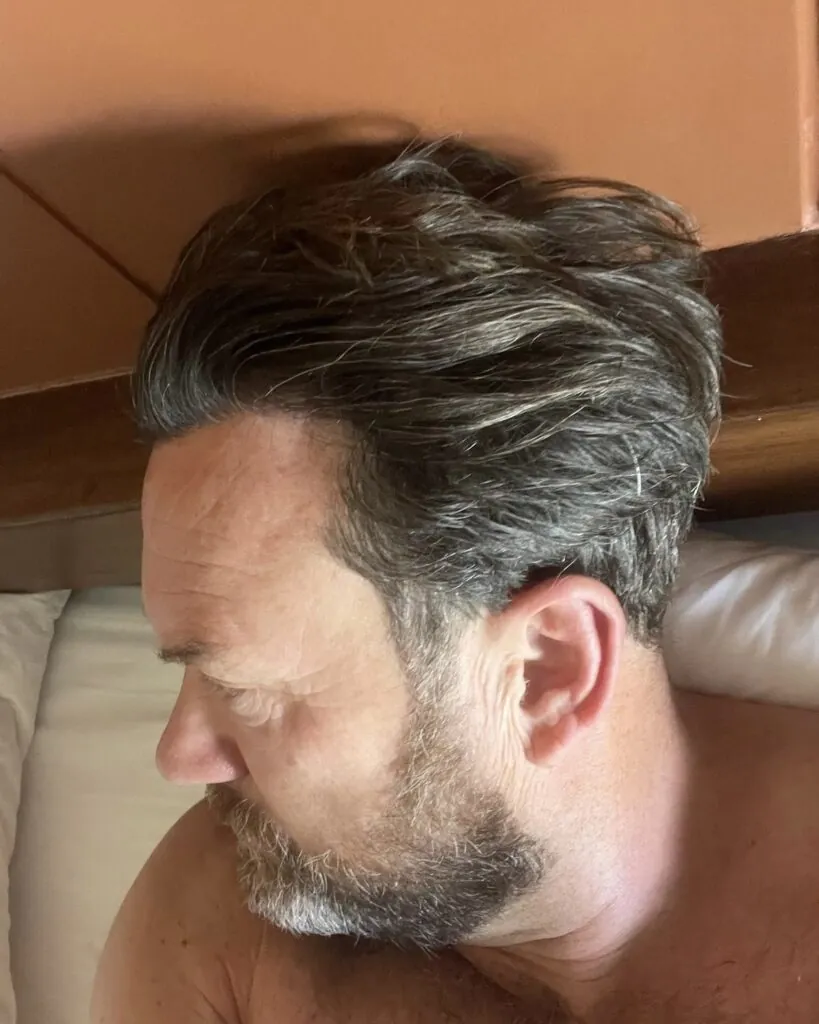 Saç ekimi sonucu, 2.100 greft, 6. yıl (6) — Hair of Istanbul