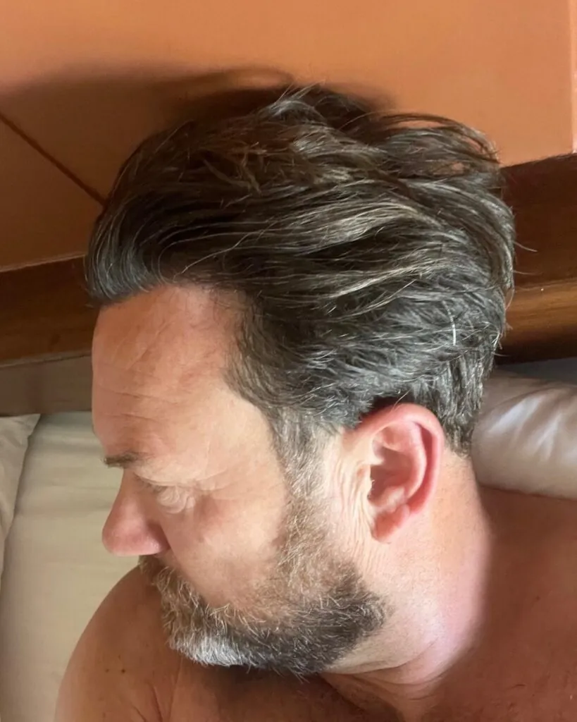 Saç ekimi sonucu, 3.000 greft, 6. yıl — Hair of Istanbul