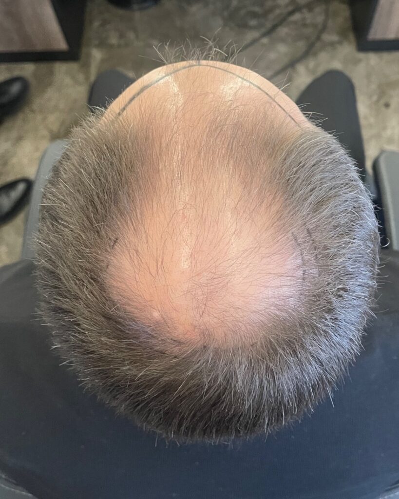 Saç ekimi sonucu, 4.500 greft, Öncesi (4) — Hair of Istanbul