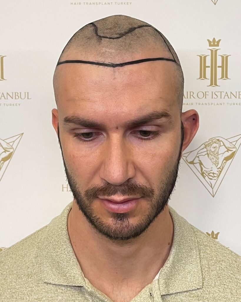 Saç ekimi sonucu, 3.000 greft, Saç çizgisi tasarımı (2) — Hair of Istanbul