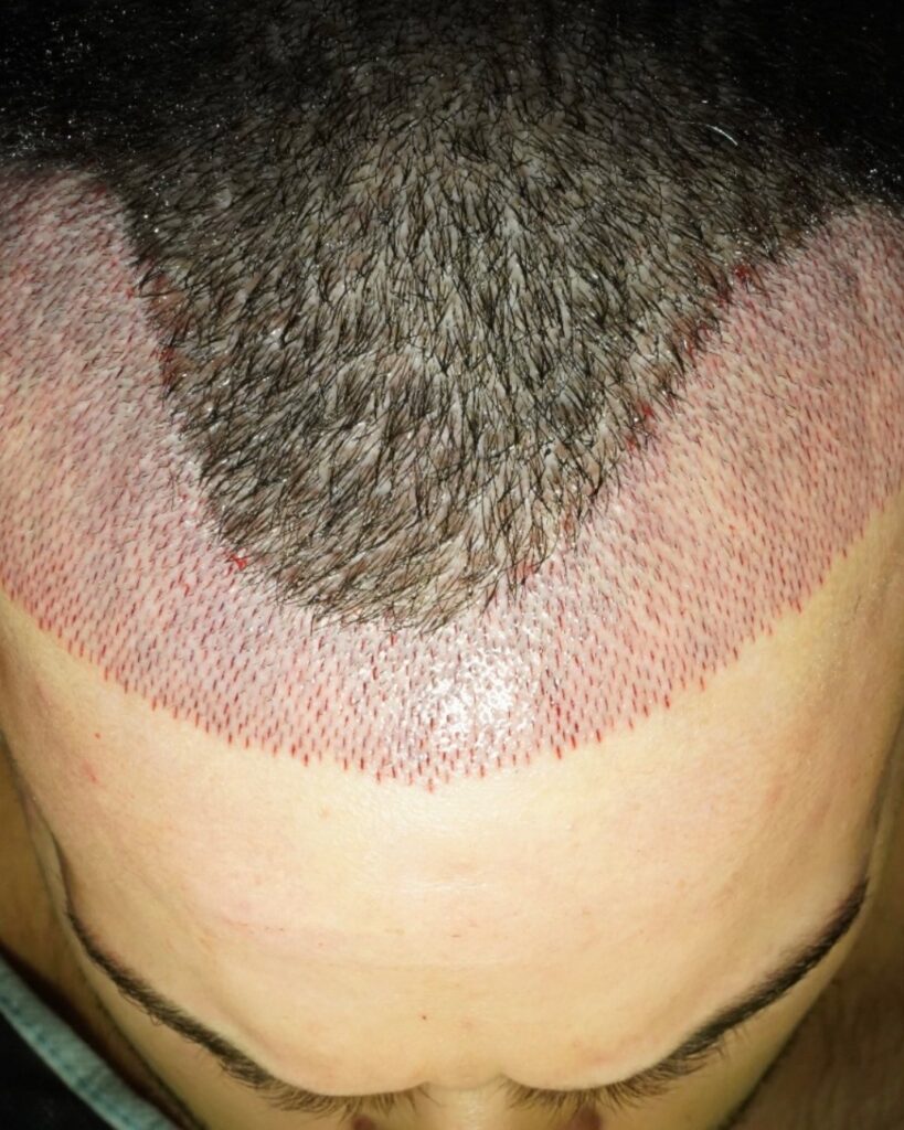 Saç ekimi sonucu, 3.000 greft, Öncesi (2) — Hair of Istanbul