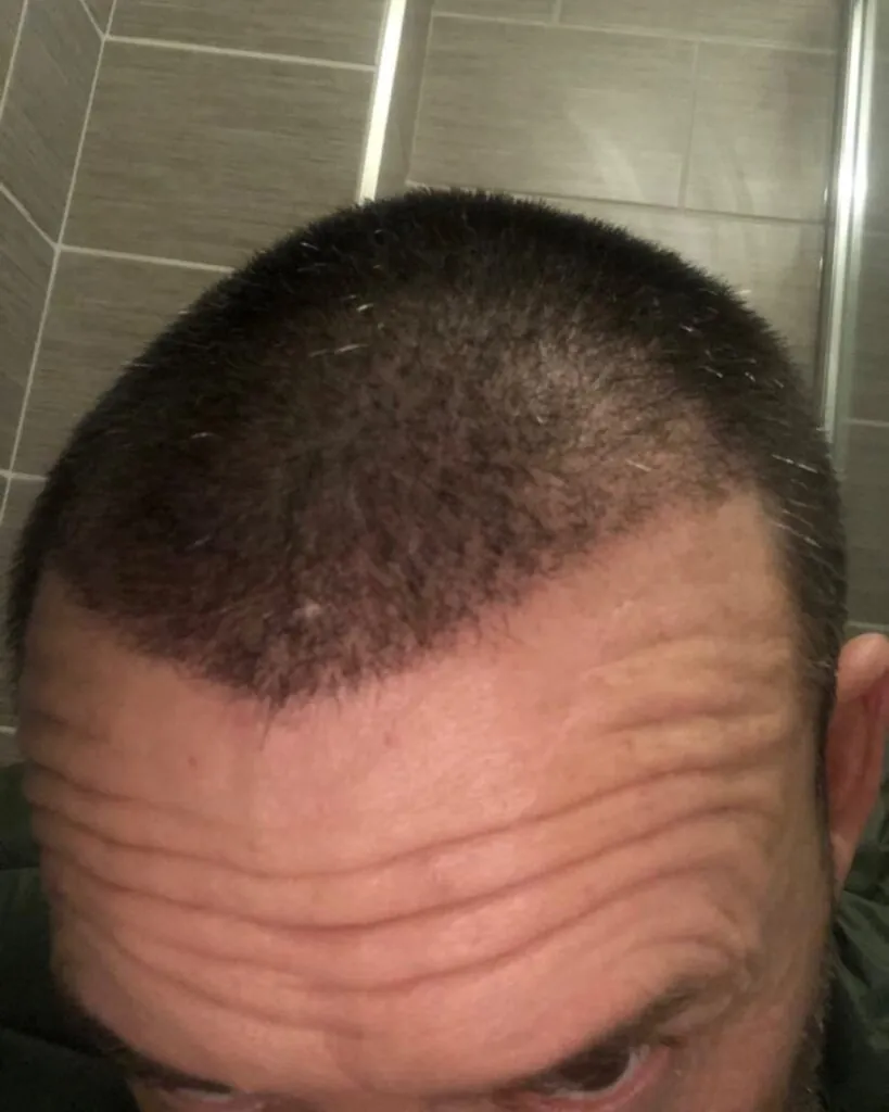 Saç ekimi sonucu, 3.000 greft, 1. ay — Hair of Istanbul