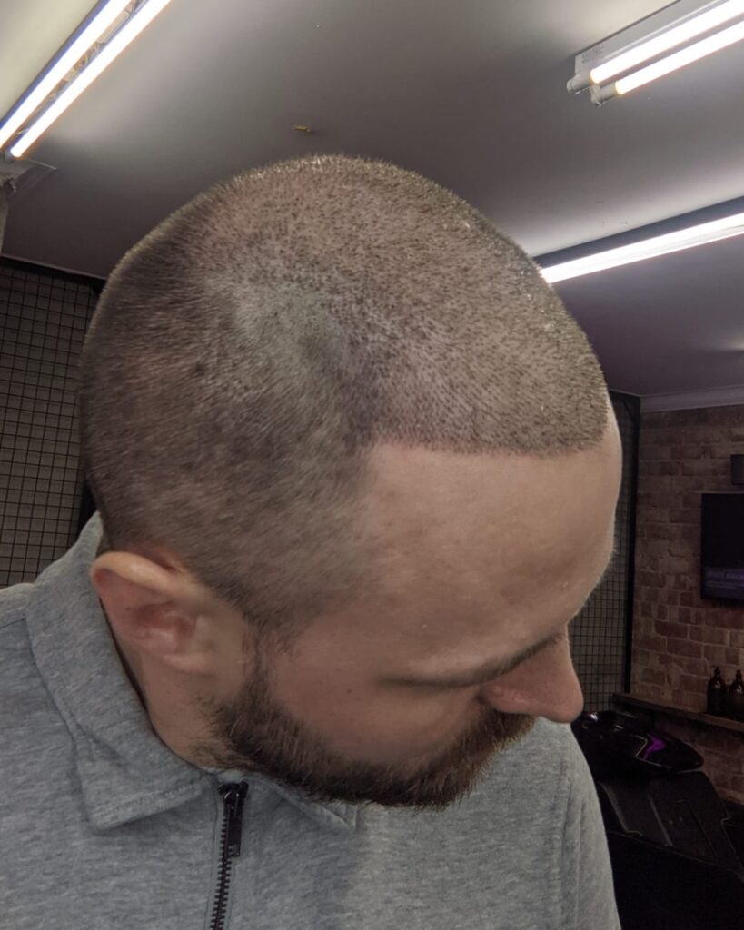 Saç ekimi sonucu, 4.500 greft, 10. gün (2) — Hair of Istanbul