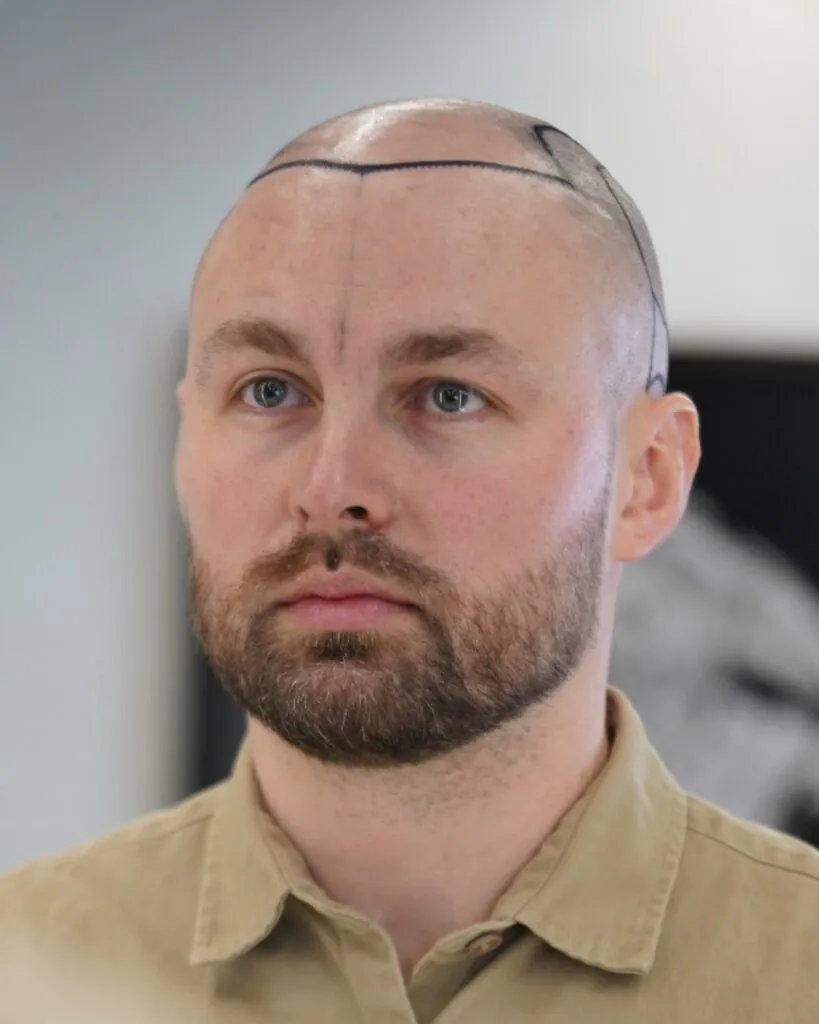 Saç ekimi sonucu, 4.500 greft, Saç çizgisi tasarımı — Hair of Istanbul