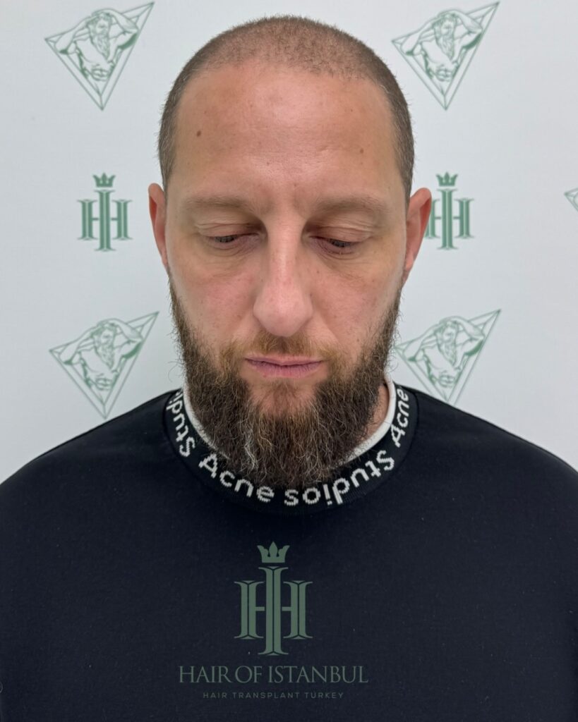 Saç ekimi sonucu, 4.550 greft, Öncesi — Hair of Istanbul