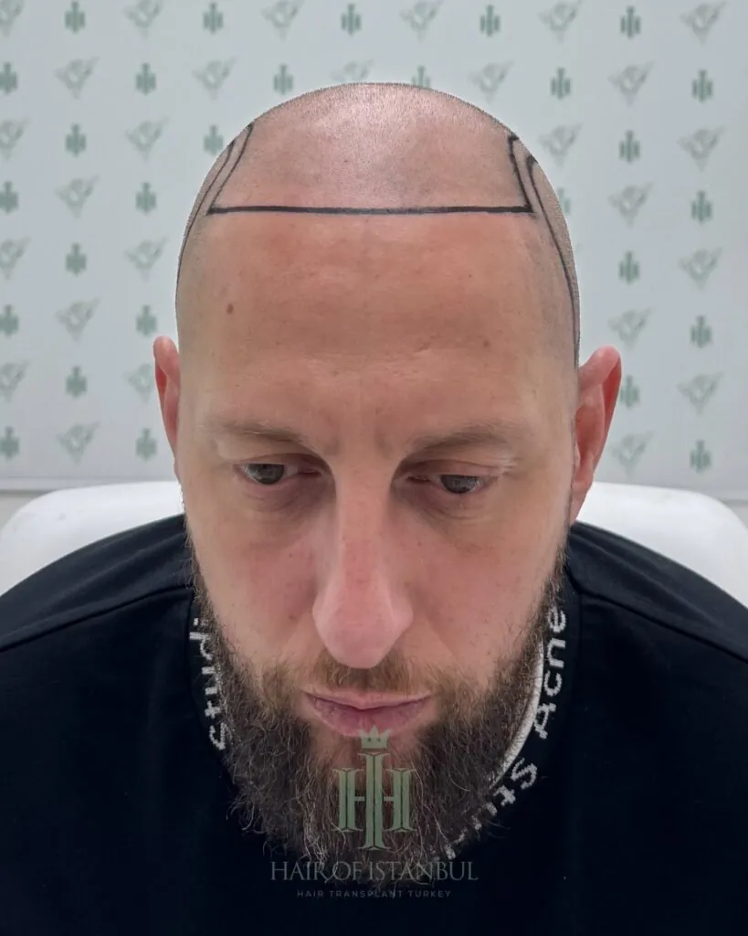 Saç ekimi sonucu, 4.550 greft, Saç çizgisi tasarımı (2) — Hair of Istanbul