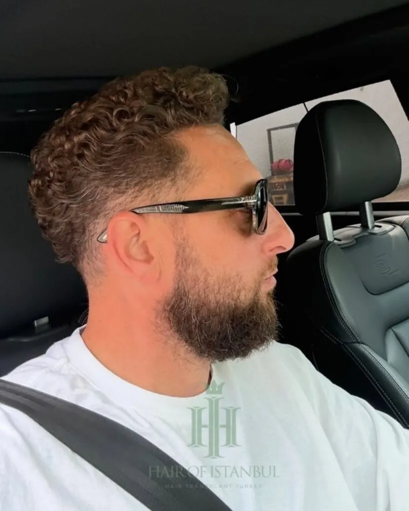 Saç ekimi sonucu, 4.550 greft, 2. yıl (2) — Hair of Istanbul