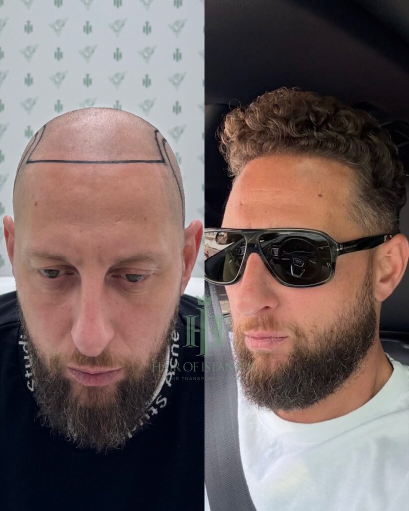 Saç ekimi sonucu, 4.550 greft, Öncesi & Sonrası — Hair of Istanbul
