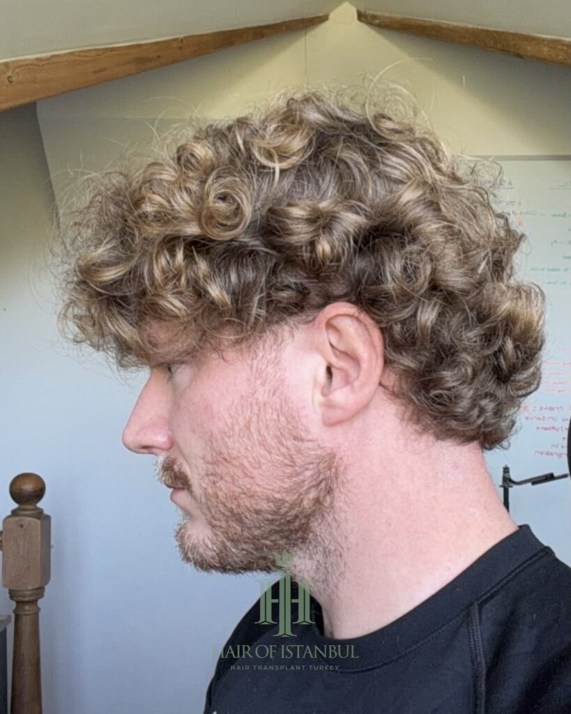 Saç ekimi sonucu, 2.700 greft, 12. ay (2) — Hair of Istanbul